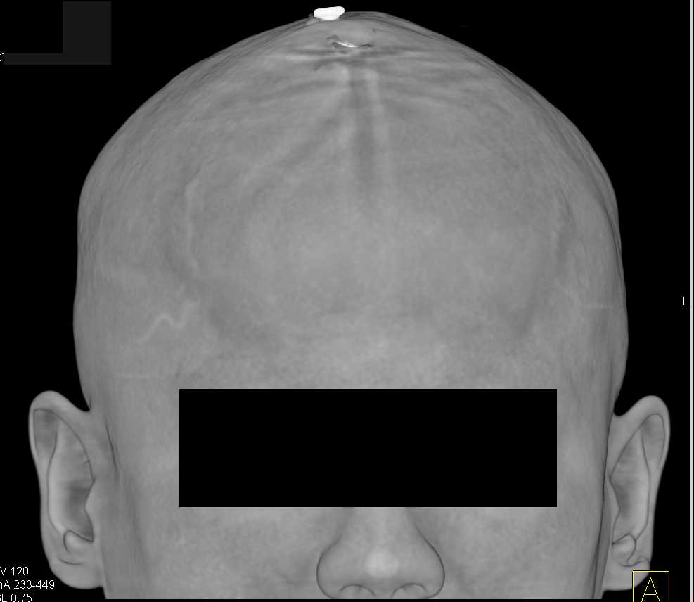 Trauma to the Skull and Brain - CTisus CT Scan