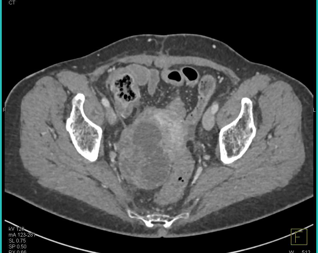 Ovarian Cancer with Uterus Involvement - OB/GYN Case Studies - CTisus