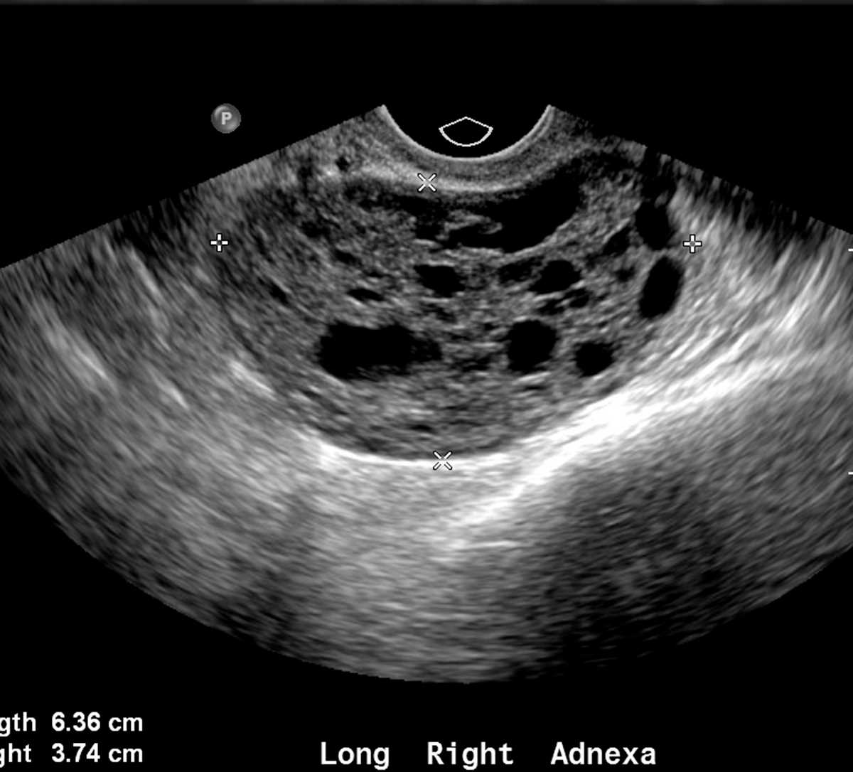 Ovarian Granulosa Cell Tumor Obgyn Case Studies Ctisus Ct Scanning