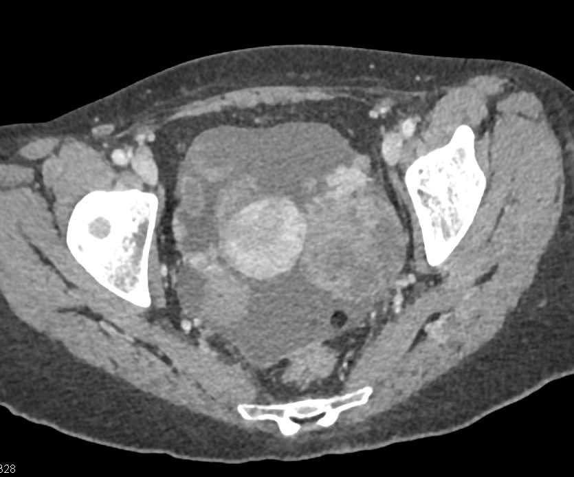 Small Bowel Obstruction with Carcinomatosis due to Ovarian ...