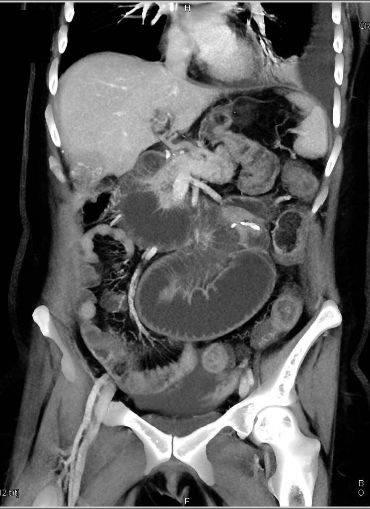 Small Bowel Obstruction With Carcinomatosis Due To Ovarian Cancer Ob