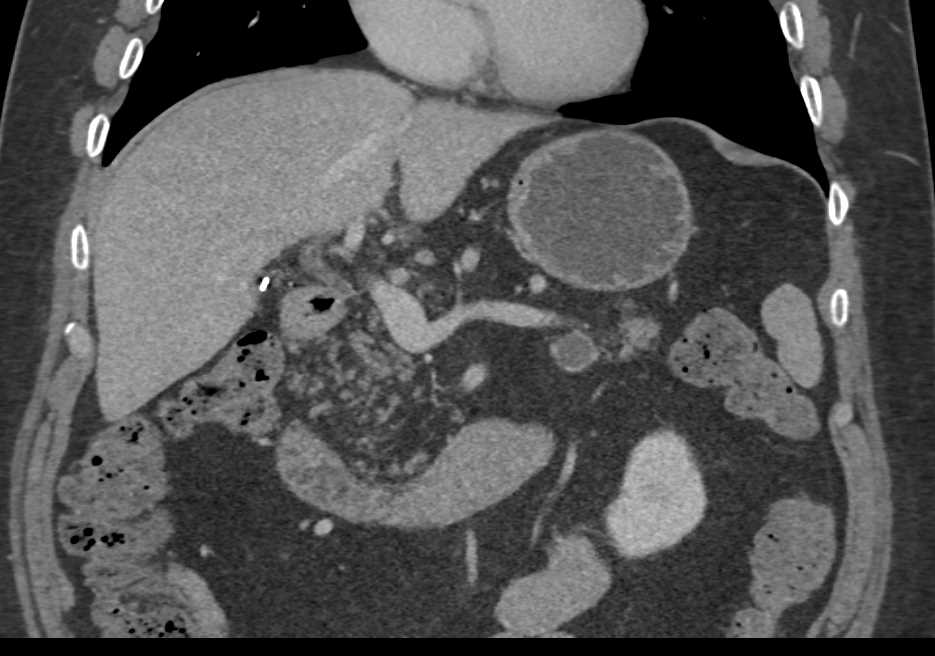 Fatty Infiltration of the Pancreas - Pancreas Case Studies - CTisus CT