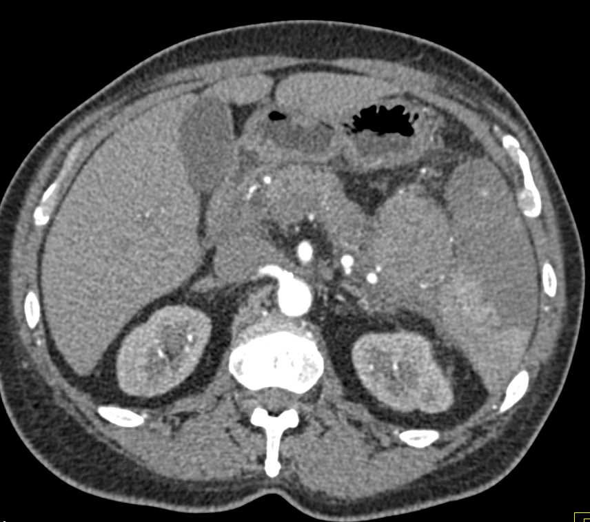 Pancreatitis and Splenic Infarct - CTisus CT Scan