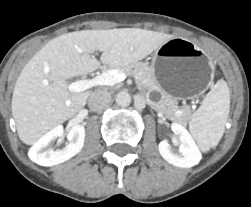 Cystic Neuroendocrine Tumor of the Pancreas - CTisus CT Scan