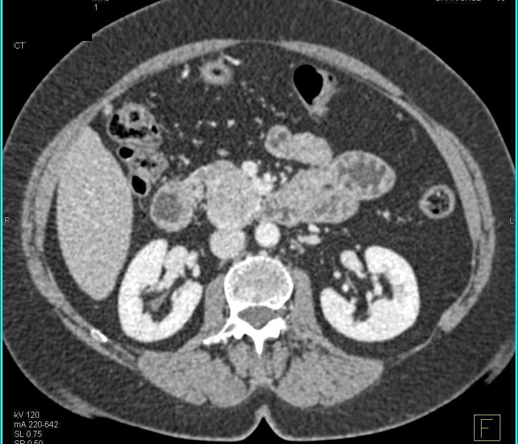 Neuroendocrine Tumor Head of Pancreas - CTisus CT Scan