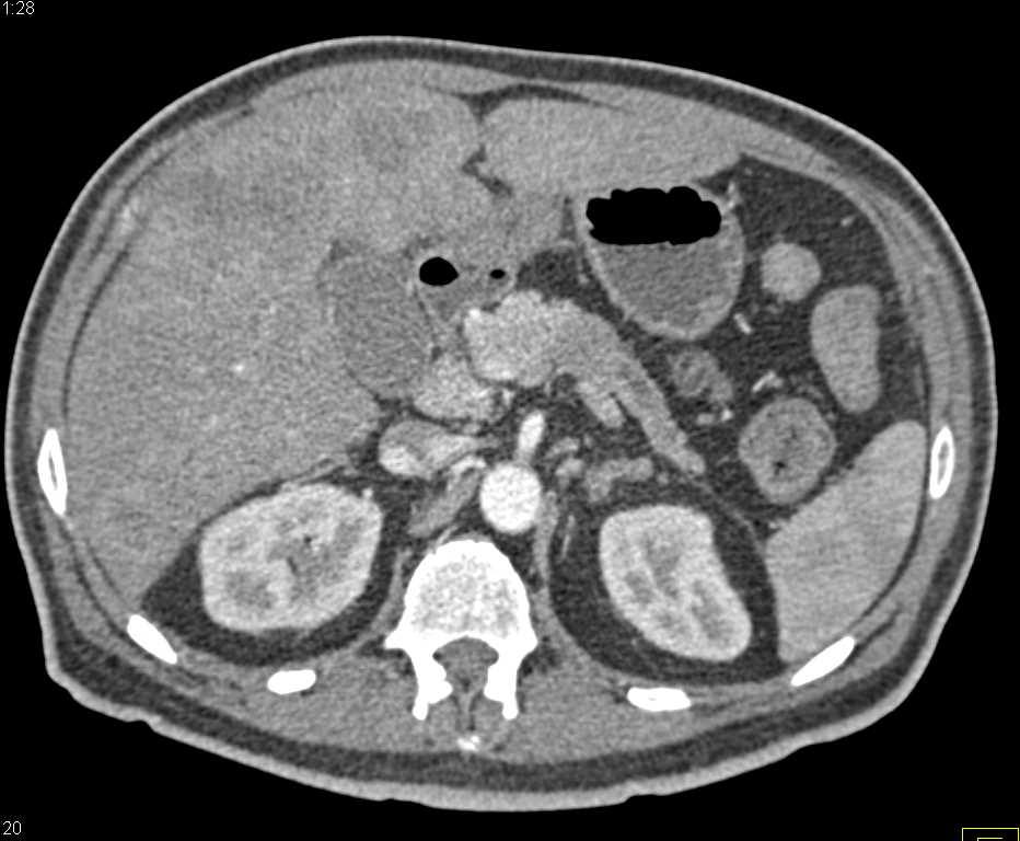 Pancreatic Cancer with Liver and Bone Metastases