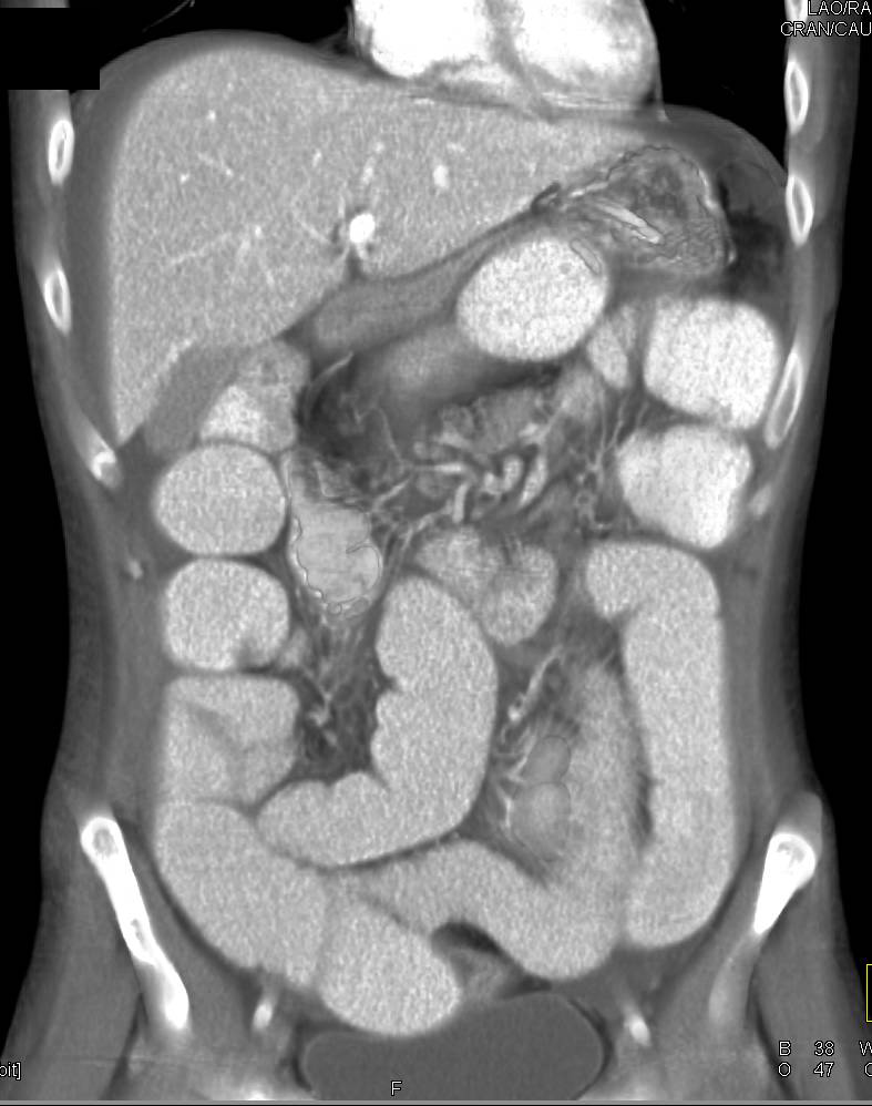 Pneumoperitoneum With Small Bowel Obstruction Small Bowel Case