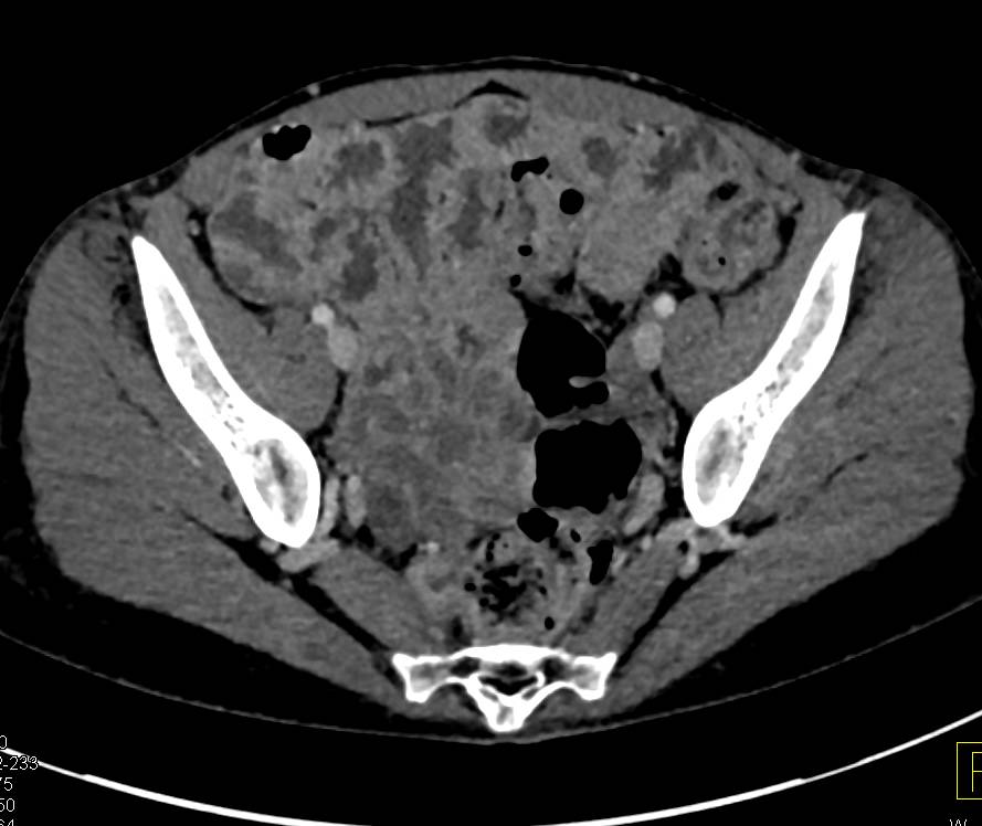 Diffuse Thickening Of Small Bowel Small Bowel Case Studies CTisus 