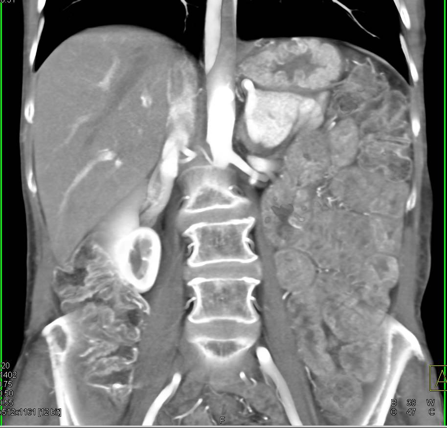 Thickening Of Proximal Jejunal Small Bowel Loops Small Bowel Case 