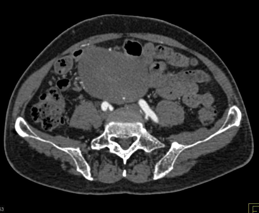 Ulcerating Small Bowel GIST Tumor - CTisus CT Scan