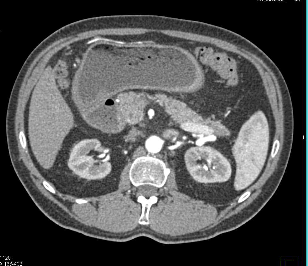 Duodenal Adenocarcinoma Causes Gastric Outlet Obstruction - CTisus CT Scan