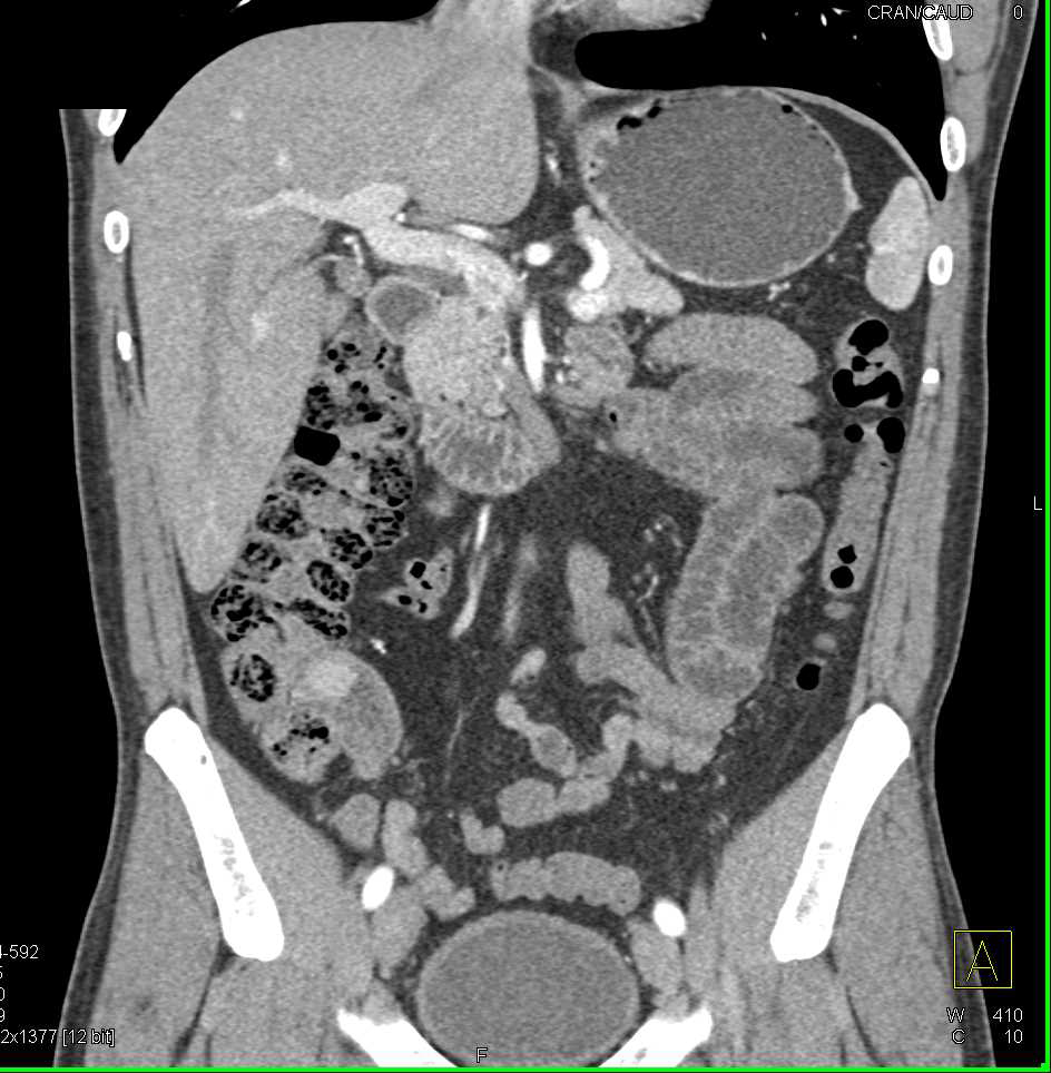Carcinoid Tumor In The Terminal Ileum Small Bowel Case Studies