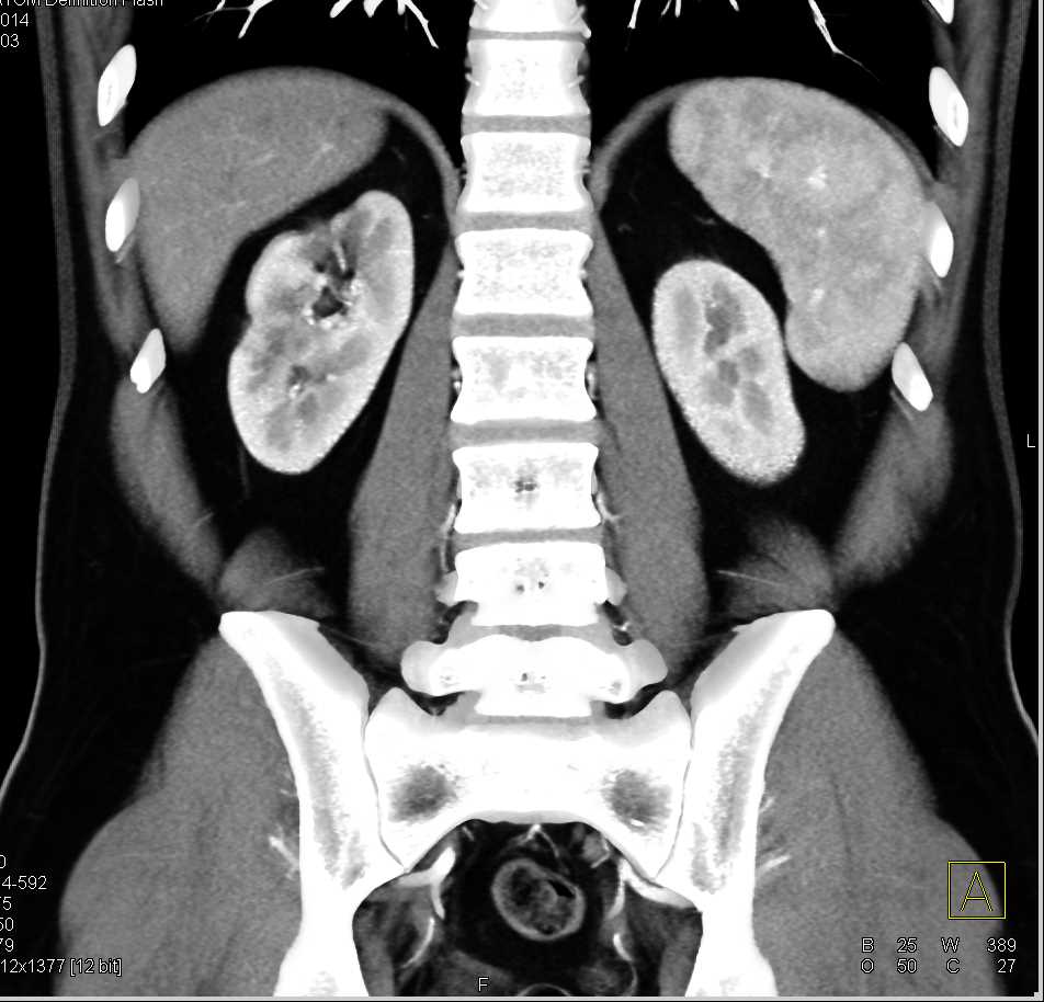 Carcinoid Tumor in the Terminal Ileum - CTisus CT Scan