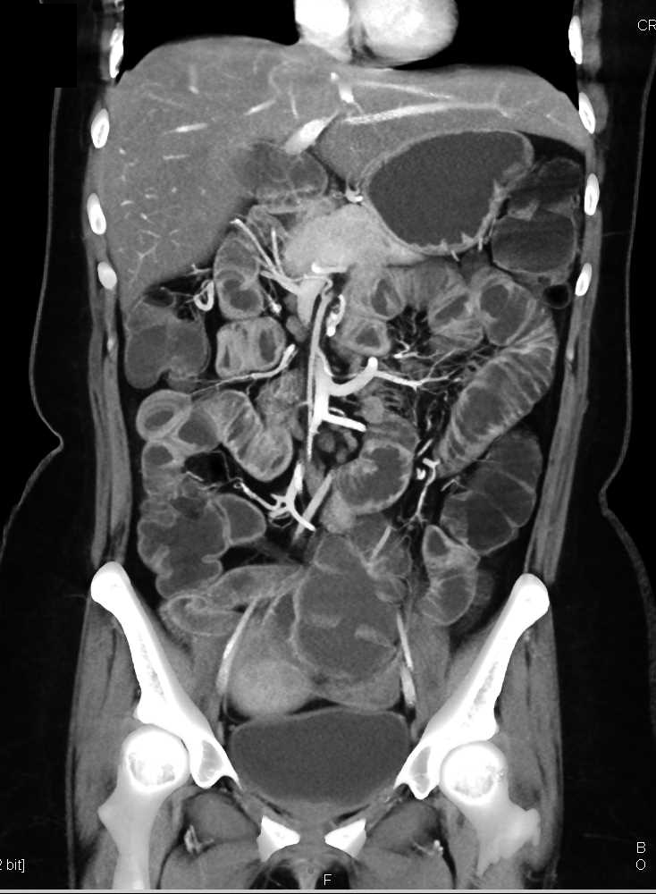 Thickened Small Bowel Loops due to Inflammatory Bowel Disease (IBD) - CTisus CT Scan