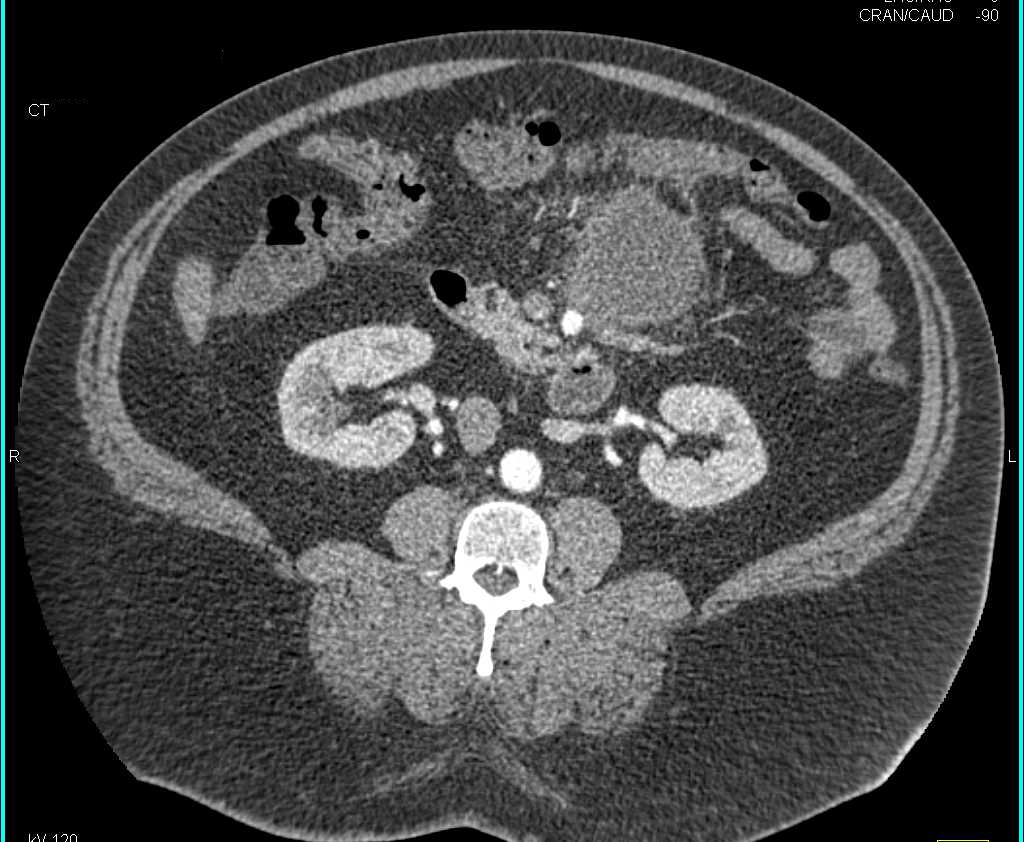 Lymphoma in the Mesentery with a Large Mass - CTisus CT Scan