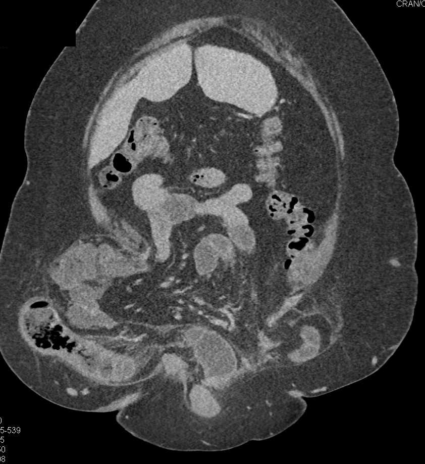 Small Bowel Obstruction (SBO) with Large Right Inguinal Hernia - CTisus CT Scan