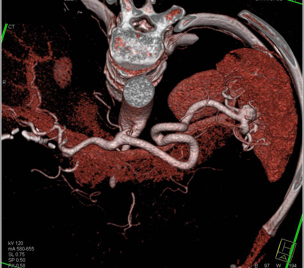 3d Rendering Of A Splenic Artery Aneurysm Spleen Case Studies