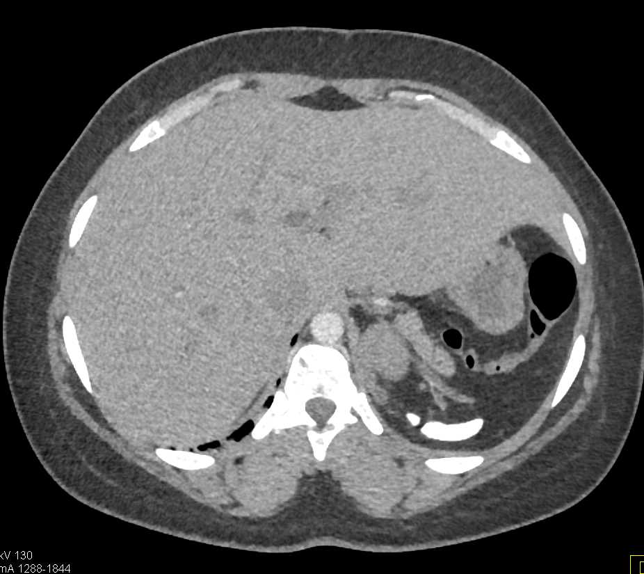 Sickle Cell Disease with Auto-Splenectomy - CTisus CT Scan
