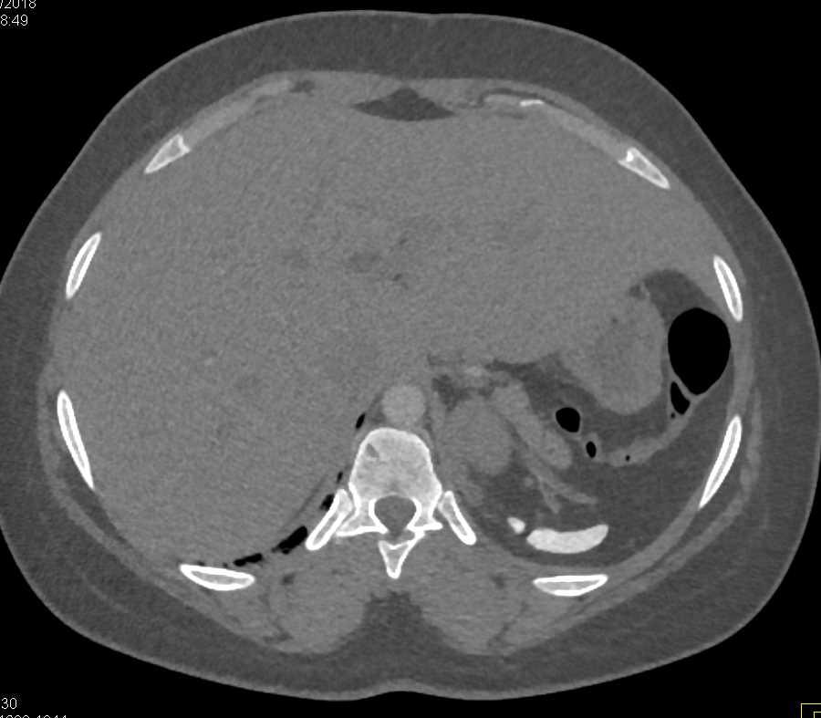 Sickle Cell Disease with Auto-Splenectomy - CTisus CT Scan