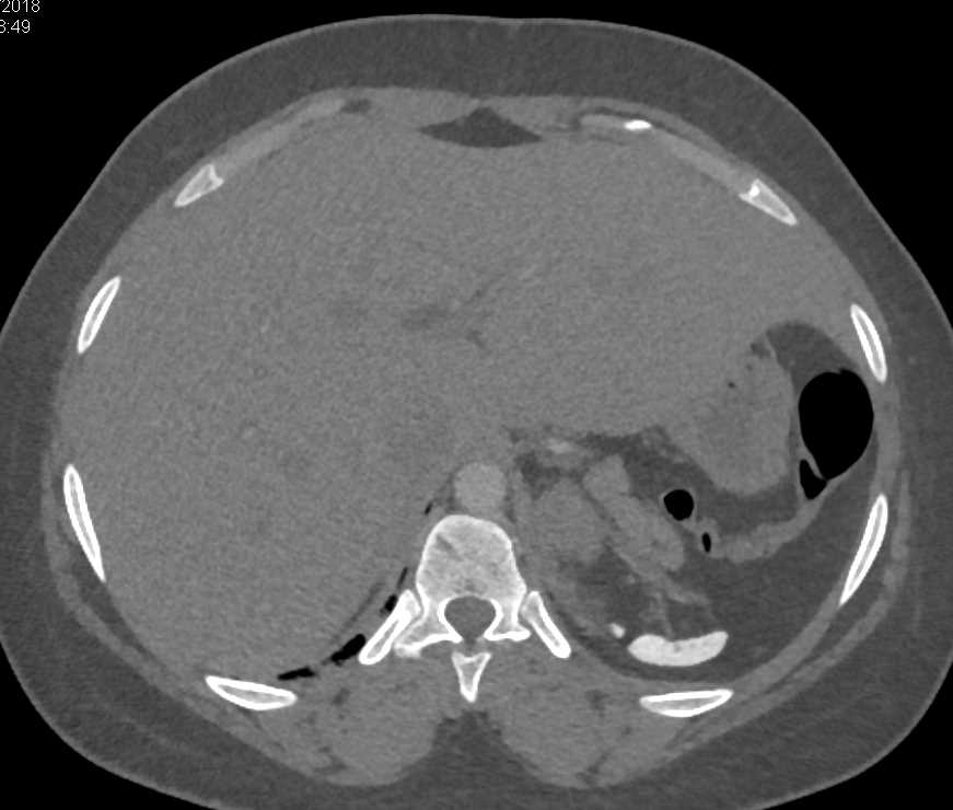 Sickle Cell Disease with Auto-Splenectomy - CTisus CT Scan