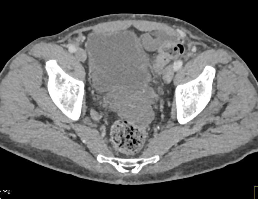 Gastric Cancer with Pseudomyxoma Peritonei (PMP) - CTisus CT Scan