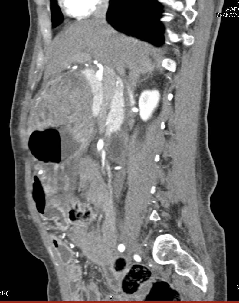 Bulky Polypoid Mass in Gastric Antrum - CTisus CT Scan