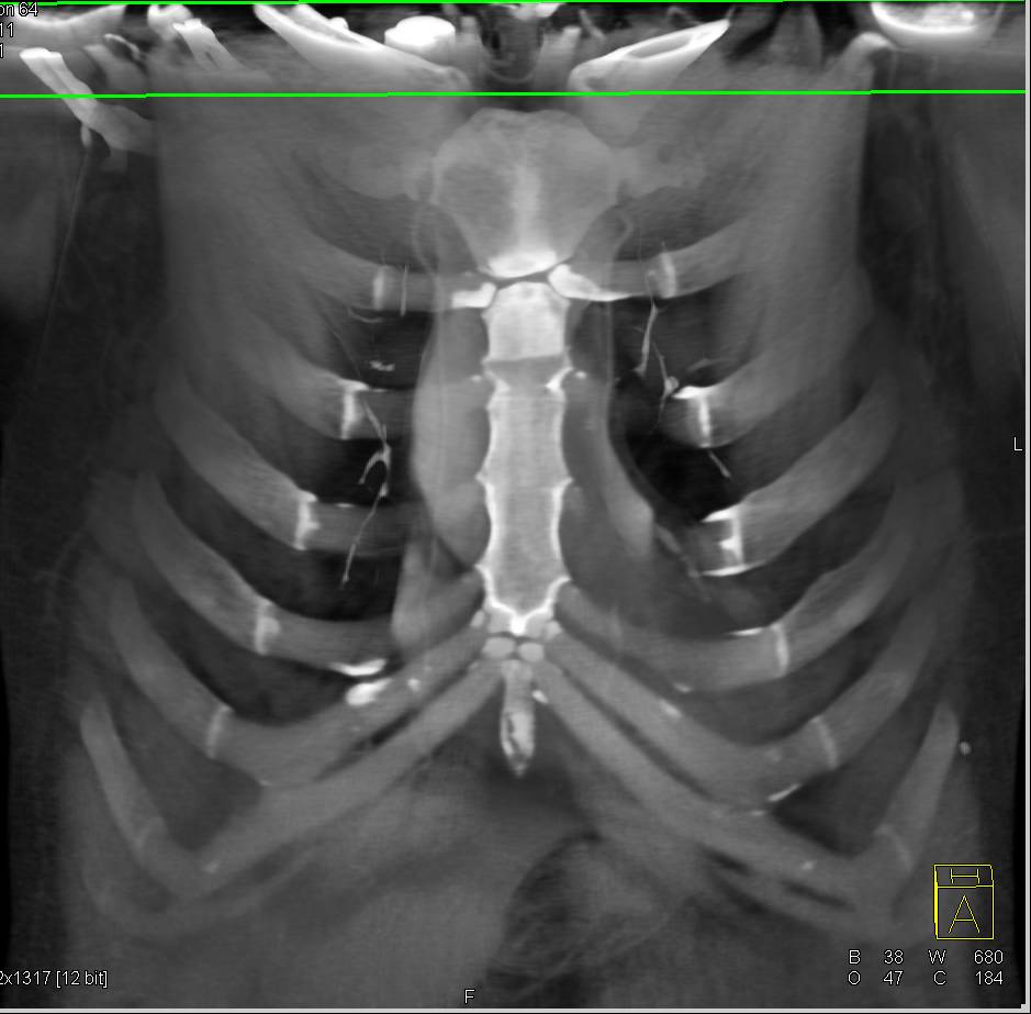 Ct Chest Muscle Anatomy