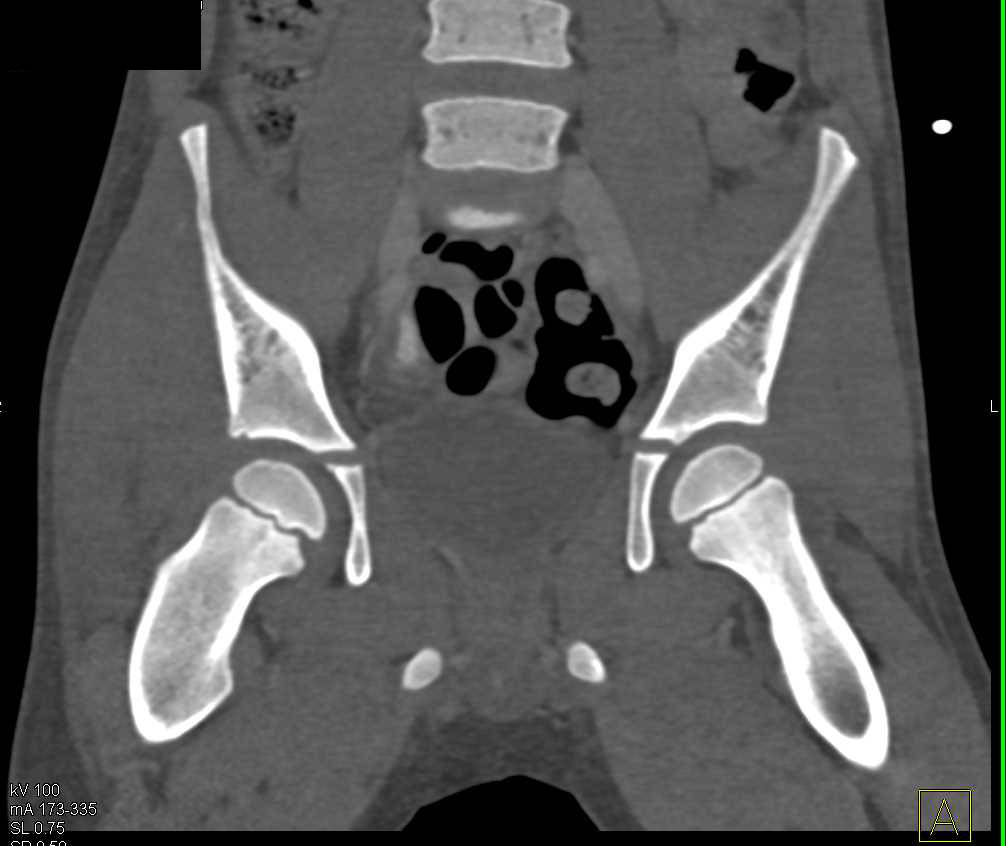 Right Iliac Wing Fracture - Trauma Case Studies - CTisus CT Scanning