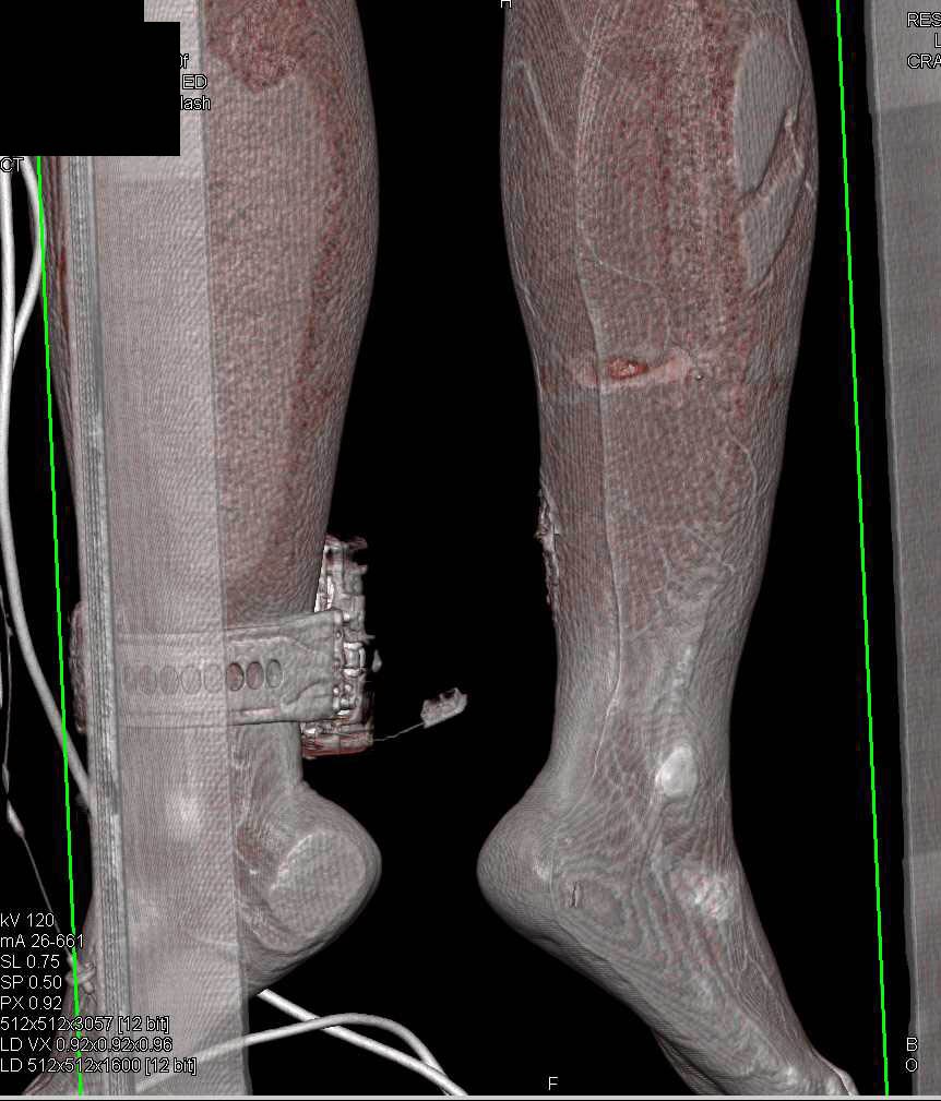 Comminuted Fracture with Vascular and Soft Tissue Injury - CTisus CT Scan