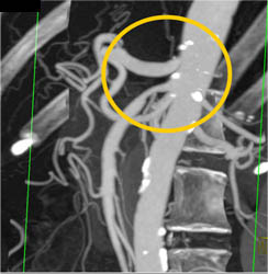 Sma Stenosis - Vascular Case Studies - CTisus CT Scanning
