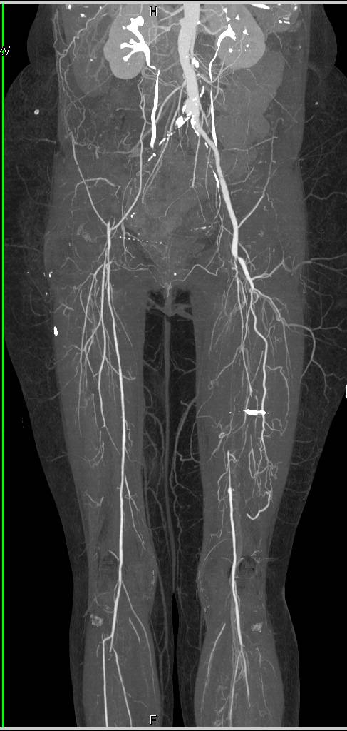 CTA Runoff with Occlusion of the Right Common Iliac Artery and Left