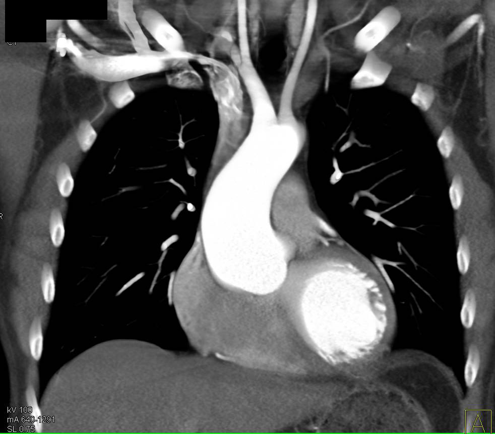 dilated-aortic-root-in-marfans-syndrome-vascular-case-studies