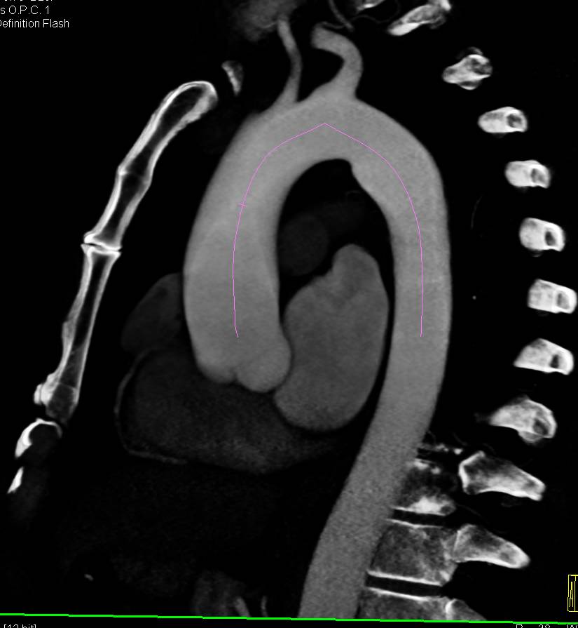 Mildly Dilated Aortic Root and Ascending Aorta - Vascular Case Studies