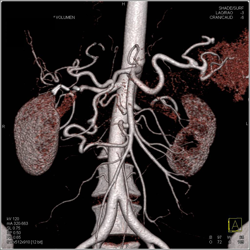 Stenosis Celiac Artery Origin With Flow Thru GDA And Into SMA 