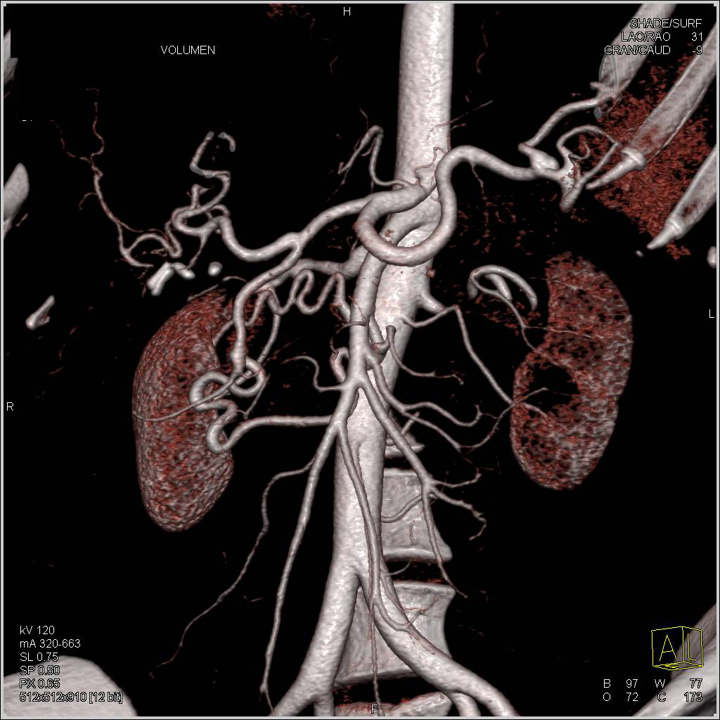 Stenosis Celiac Artery Origin With Flow Thru GDA And Into SMA 