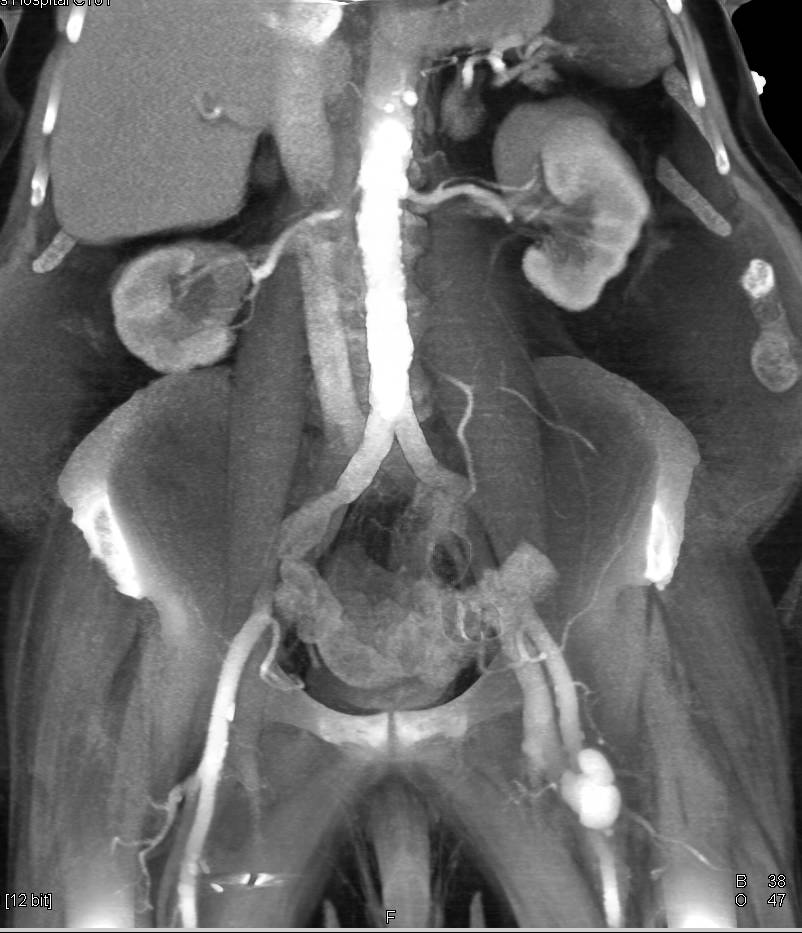 Pseudoaneurysm Left Groin With Arteriovenous Av Fistulae Best Seen On