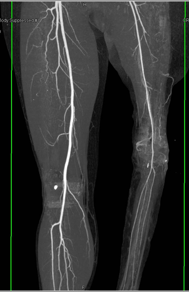 CTA Runoff in Patient with Reimplanted Lower Extremity - Vascular Case