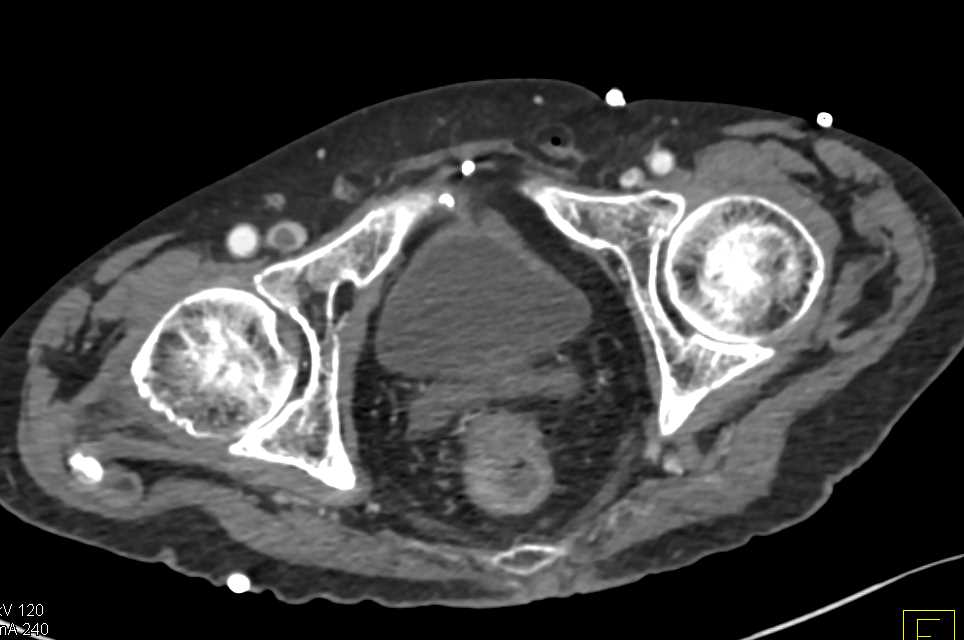 Right Femoral Vein DVT - Vascular Case Studies - CTisus CT Scanning
