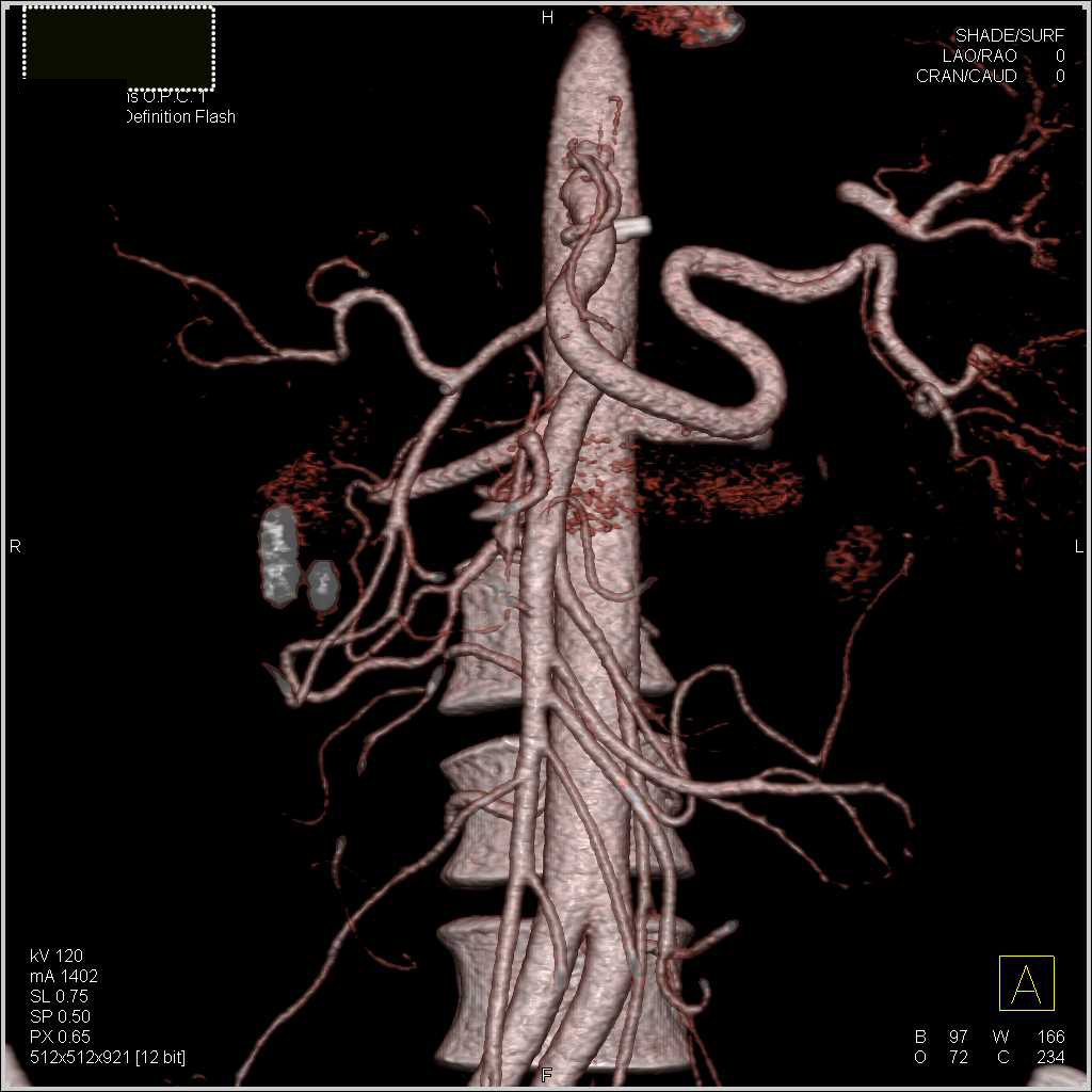 Celiac Artery Stenosis