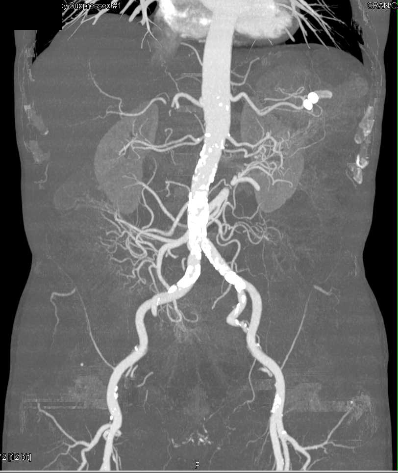 CTA Evaluation of the Abdominal Aorta with Dual Energy and Bone Removal