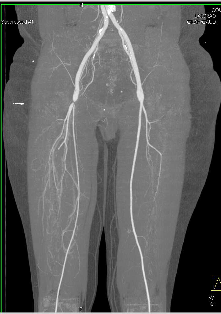 What Is Femoral Artery Stenosis