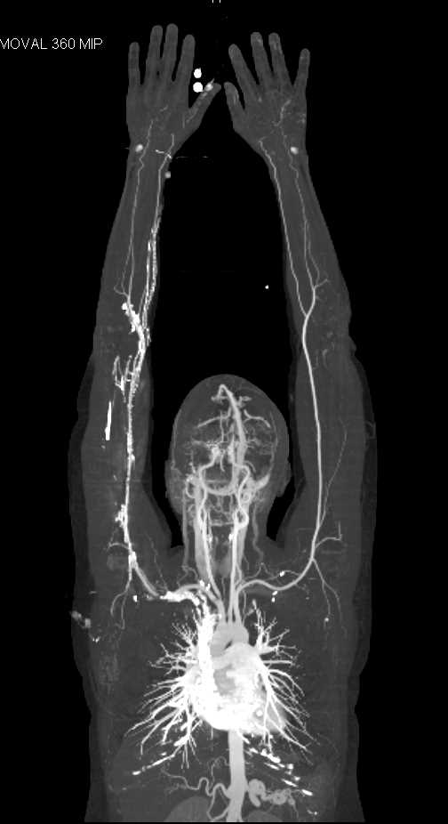 CTA of the Upper Extremities - Vascular Case Studies - CTisus CT Scanning