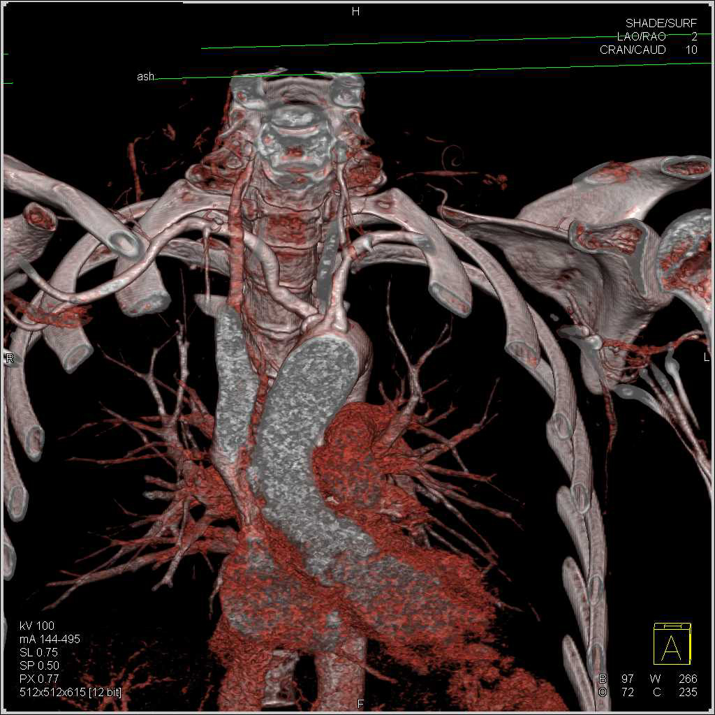 Subclavian Artery Stenosis With Plaque In Right Subclavian Artery