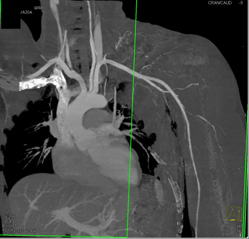 CTA with Patent Left Axillary to Brachial Artery - Vascular Case