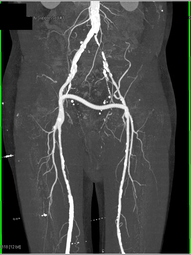 Cta With Fem Fem Bypass Graft And Occluded Left Common Iliac Artery And Stenosis Of Celiac