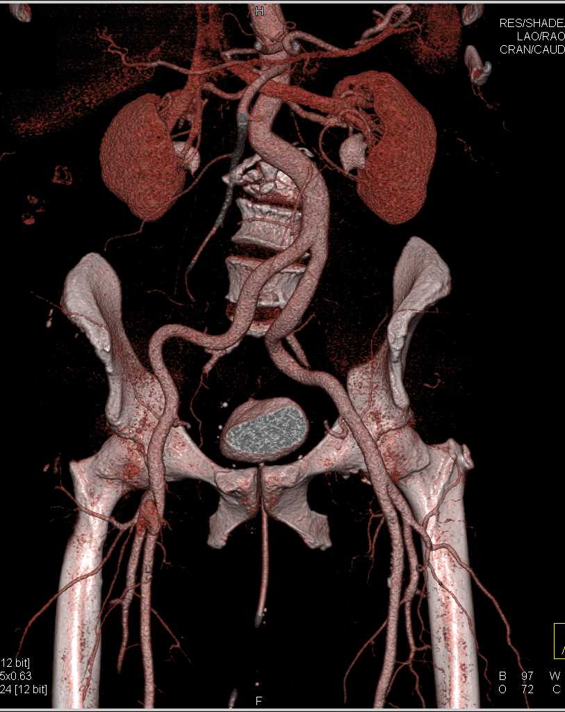 Pseudoaneurysm with Bleed in the Right Femoral Artery - CTisus CT Scan
