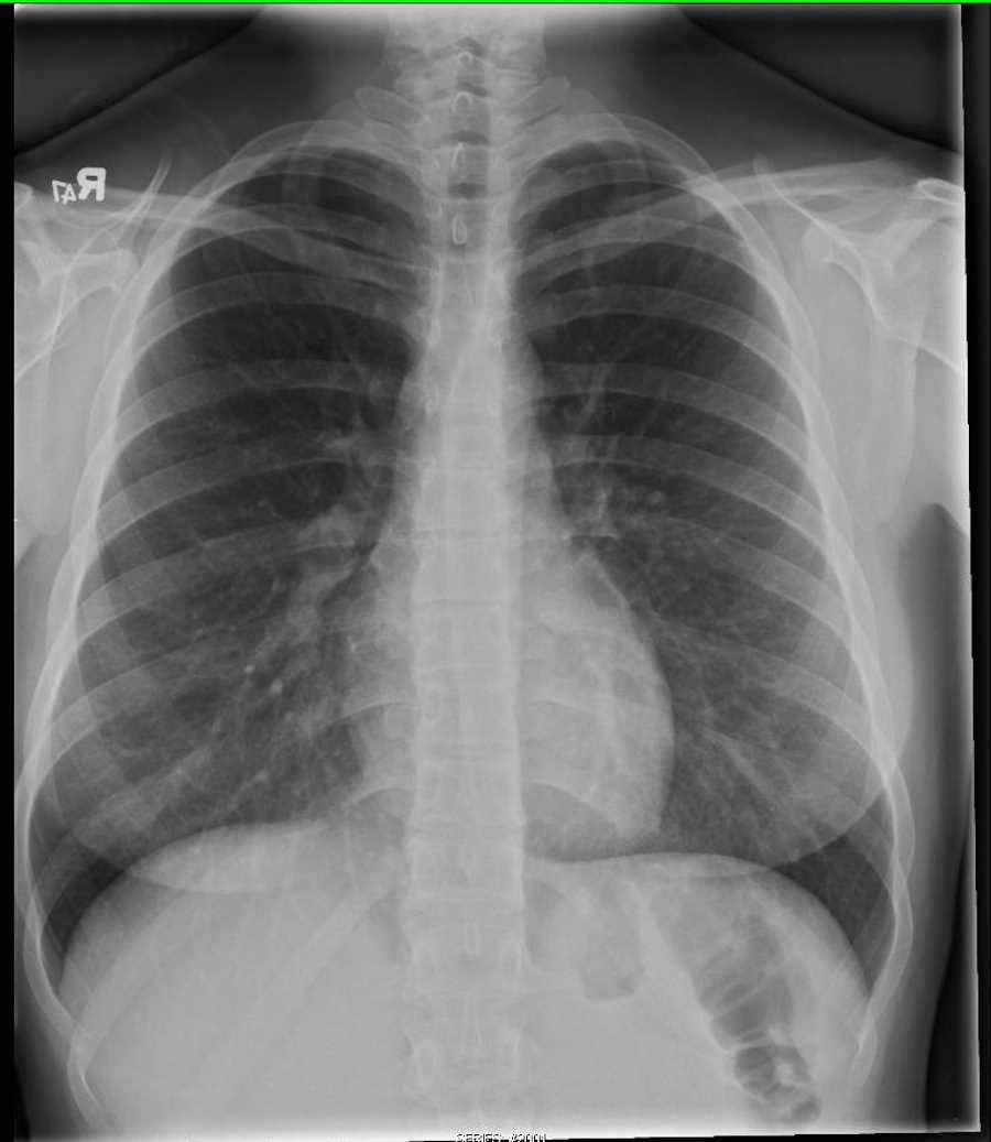 Normal Chest X ray X Rays Case Studies CTisus CT Scanning