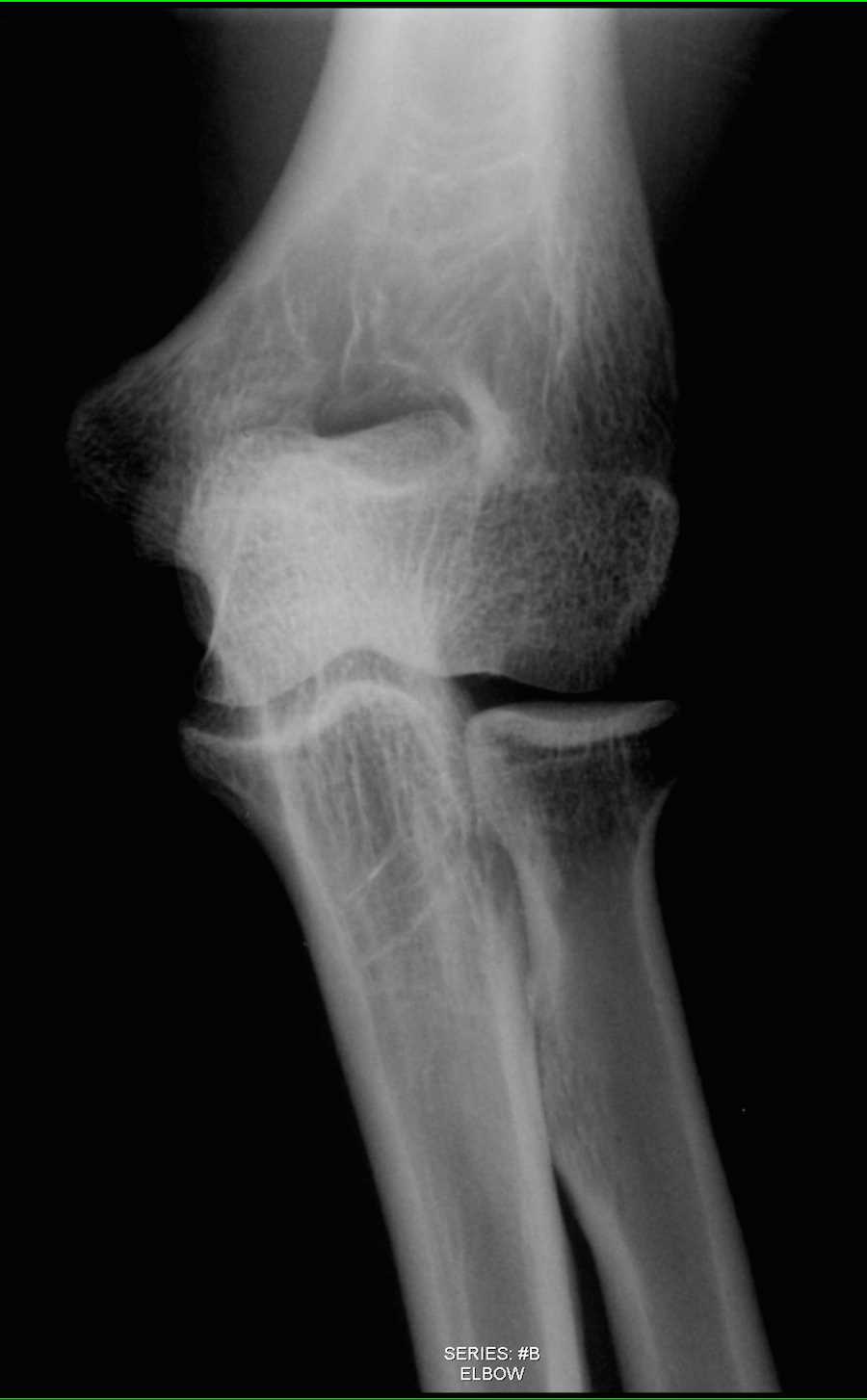 Normal Elbow on X-ray - X Rays Case Studies - CTisus CT Scanning