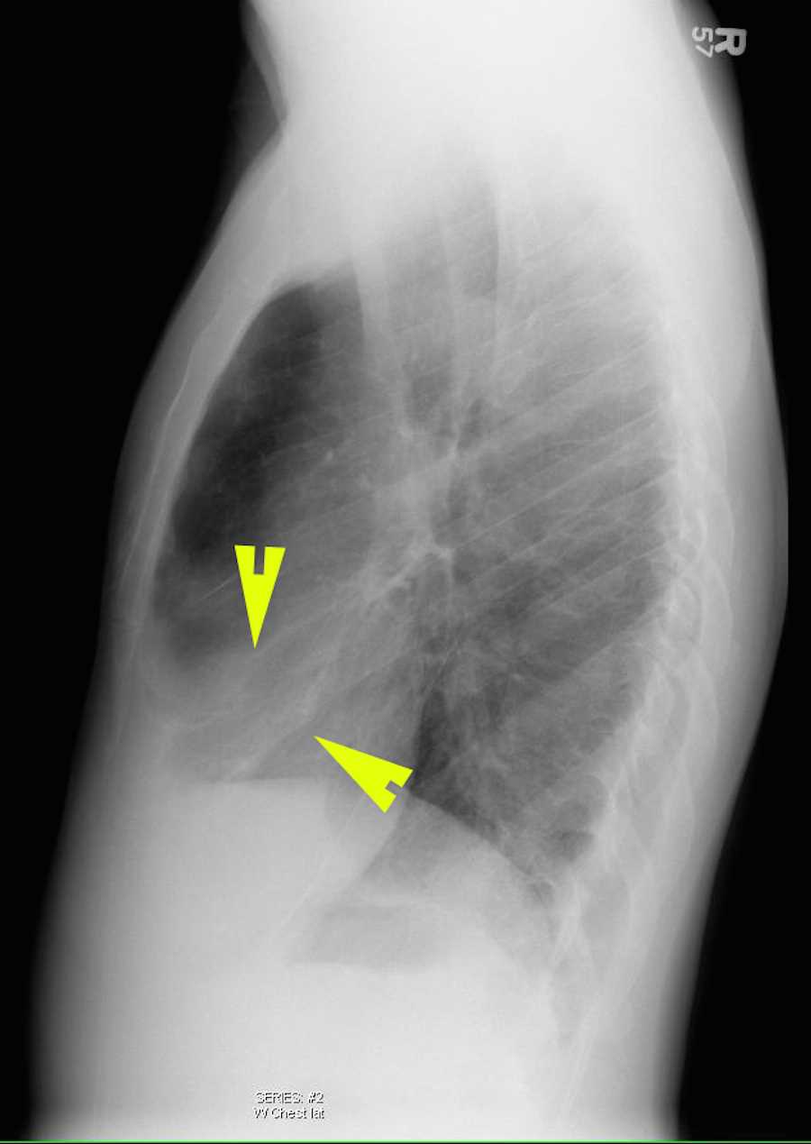 Right Middle Lobe Pneumonia X Rays Case Studies CTisus