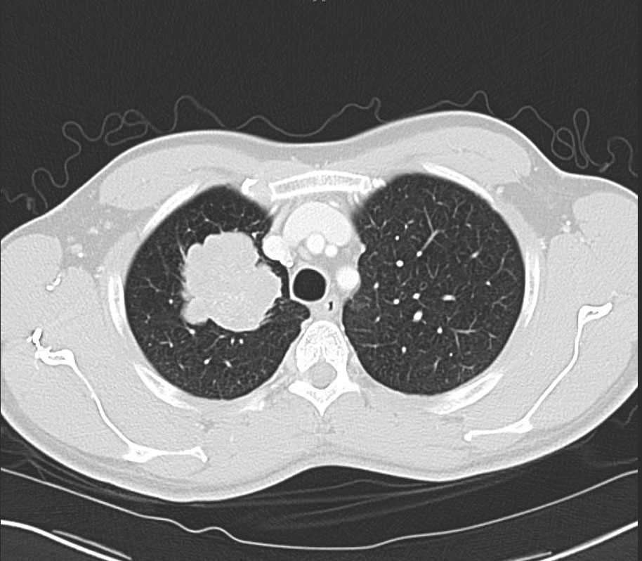 Right Upper Lobe Lung Cancer On X Ray And Ct X Rays Case Free Nude Porn Photos
